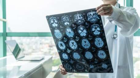 Doctors looking at a brain scan