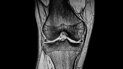 CT Scan Knee joint