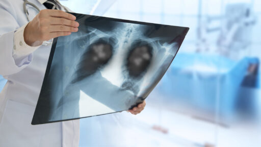 Doctor looking at Lung cancer xray