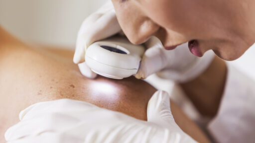 Skin Cancer Care, doctor examining mole on back