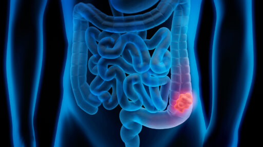 Colon Cancer Treatment