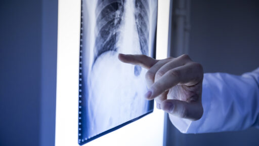 Primary Bone Cancer