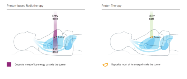 Image showing how the proton therapy works. During therapy, a powerful beam of protons is delivered to the precise site of a tumor. Once the proton beam reaches the tumor, it conforms to its shape and depth, and only then releases its full energy. It then stops, sparing surrounding healthy tissue.