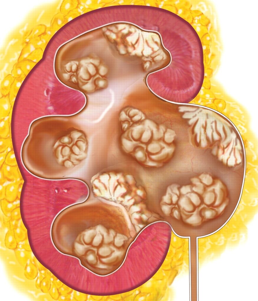 An example of high-volume
urothelial tumors in the kidney.