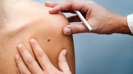 Skin Cancer Treatment
