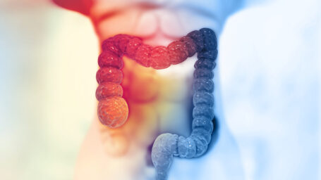 Anal Cancer Prevention