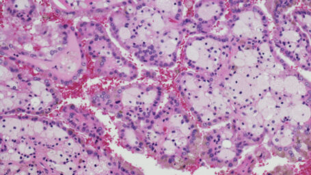 Renal Cell Cancer