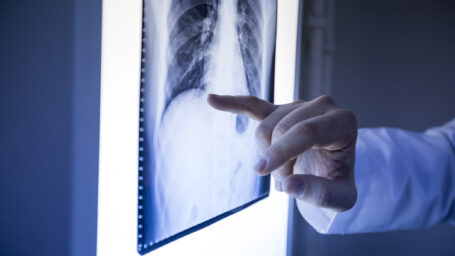 Primary Bone Cancer