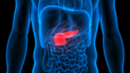 Pancreatic Neuroendocrine Tumors