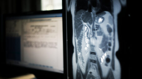 Bile Duct Cancer Treatment