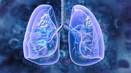 Lung Cancer
