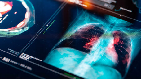 Lung Cancer Research