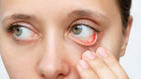 Cropped shot of a young caucasian woman showing off her red inflamed conjunctiva and dilated capillaries. Hemorrhage under the conjunctiva. Disease of retina of the eye. Conjunctivitis, keratitis