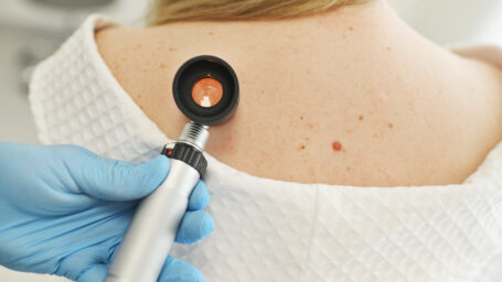doctor checking for skin cancer