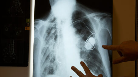 Hands examining pacemaker x-ray